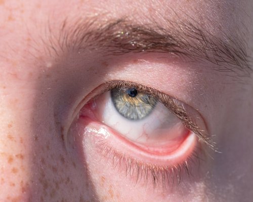illustration of eye strain symptoms